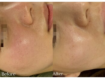 レイ(Lei)/毛穴/エイジング/ニキビ/妻田