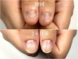 2ヶ月後の変化 深爪解消♪自爪風
