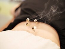 ジェイペック鍼灸整骨院/灸頭鍼【肩こり・腰痛に】