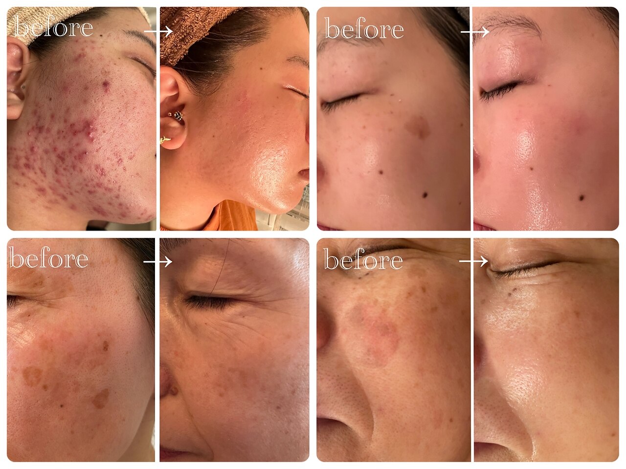 シンデレラ しみケア(Cinderella)｜ホットペッパービューティー