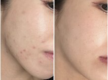 エレマヴィ(ele mavie)の雰囲気（スタッフ自身が効果を実感☆【ハーブピーリング/REVI/肌質改善】）