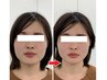 【5回目以降の方限定】小顔矯正＋頭蓋骨矯正+顔の歪み矯正￥10900→￥7900