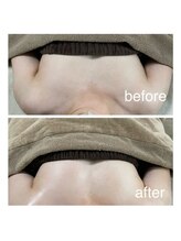 エミニナル(EMININAL)/【バストケア】ビフォーアフター