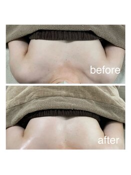 エミニナル(EMININAL)/【バストケア】ビフォーアフター