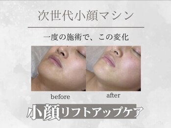 エム(eM.)/小顔リフトケア1回施術例