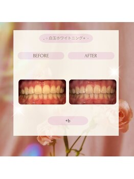 プラスビーセルフ(+b self)/ホワイトニングビフォーアフター