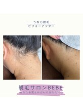 ベベ(Bebe)/うなじ脱毛♪