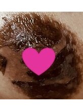 カリオン/乳輪の黒ずみ改善　桃色に