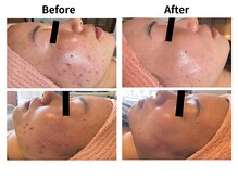 ピオラ(Piora)の雰囲気（ニキビ/毛穴にお悩みの方へ!ホワイトスノーピールで白玉美肌!!）