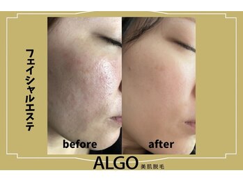 アルゴ 高槻店(ALGO)/光フォト