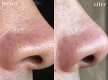 ホワイトアクア 池袋店(WHITE AQUA)/ハーブピーリング/毛穴洗浄/池袋