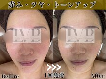 ラヴレボーテ(La Vraie Beaute)の雰囲気(岸和田 久米田/高濃度美容液導入フェイシャル1回症例)