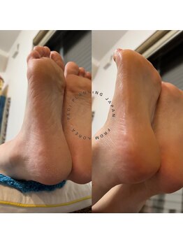 イヤシロチ/ペディプランニング・足裏角質