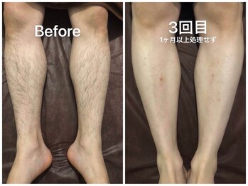 月の詩/メンズ脱毛BeforeAfter