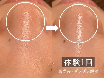 ココモンド(COCOMONDO)/ハイドロ毛穴洗浄/毛穴/毛穴洗浄