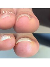 巻き爪矯正センター 沖縄 宜野湾/巻き爪矯正1回の施術での変化！