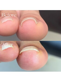 巻き爪矯正センター 沖縄 宜野湾/巻き爪矯正1回の施術での変化！