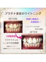 ホワイトニングプラス(Whitening+)/プラチナ美容ホワイトニング
