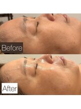 東京デトックス/シワ改善小顔リフトアップF70分