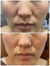 テセラ(Tethere)/ヒト幹細胞×エクソソーム結果