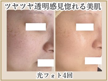 ポモナ 横浜馬車道店(Pomona)の写真/[シミ肌改善×光フォト]潜んでいるシミにも目立つシミにもアプローチ★若かりし日の肌の美しさを取り戻す！