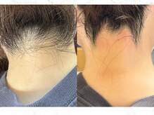 ヒーリングハーツ(Healing Hearts)/うなじ美人/シュガーリング脱毛