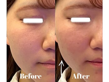 サロンビー 赤坂(SalonB)/小顔リフト/浮腫改善/美顔に！