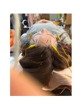 爽健美/電気を流す美容鍼【ブライダル】