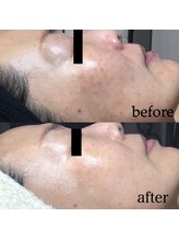 ケイリー(kaylee)/ハーブピーリング