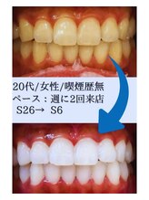 スマイルホワイト 赤羽店/ホワイトニングBefore After