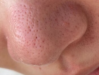 ウミ(Ummi)/施術後