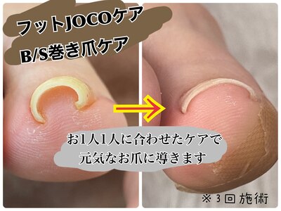 《足の爪の形でお悩みの方へ》B/Sブレイスまき爪補正＋JOCOケア