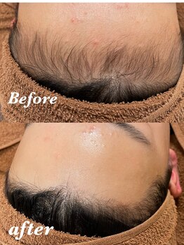 ジューンブライド(June Bride 61)/おでこ脱毛