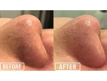 毛穴屋/毛穴詰まりも改善