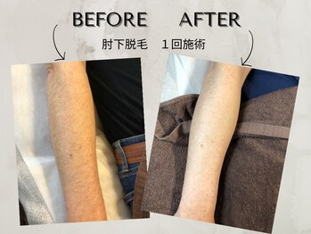 ワンアップ(One-up)/肘下脱毛 １回　before  after