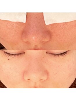 サロン ド エフ(Salon dee F)の写真/【脱肌荒れ・ニキビケア!!】毛穴診断で自分に合った最短フェイシャルケア☆肌荒れ特化コース¥8800♪