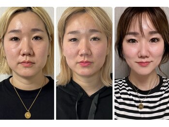 エクレクティック(ECLECTIC)/小顔/宇都宮エステ