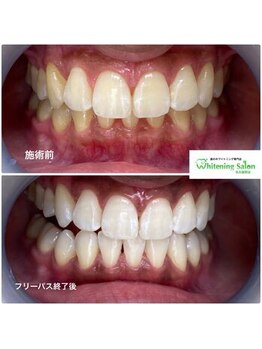ホワイトニングサロン 名古屋駅店/【ホワイトニング施術例】
