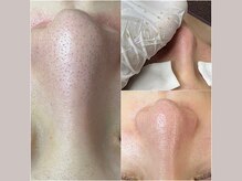 セリジェ 青山(Cerisier)/毛穴を知り尽くしたプロに！