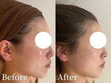 アイミーモア 国立店(aimer more)/陶肌トリートメントBef＆Aft