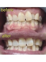 カドゥルエクラ(Cuddleclat)/ホワイトニング　Before→After