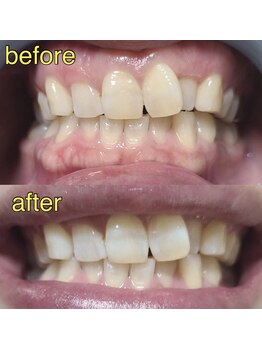 カドゥルエクラ(Cuddleclat)/ホワイトニング　Before→After