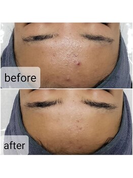 アジュール(a jour)/ハーブピーリング