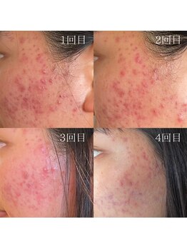 コルギと小顔矯正サロン ウンジョルノ フェリーチェ(un giorno felice)/ニキビケアもコルギで改善