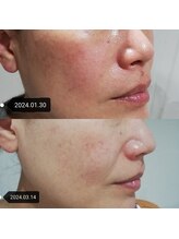 RiとBiのたまご/フェイシャル 2ヵ月before-after