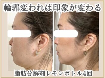 ポモナ 横浜馬車道店(Pomona)の写真/【驚愕の小顔術】韓国の最新脂肪分解“レモンボトル”で圧倒的な小顔へ!!輪郭のもたつき・二重あごを解消！
