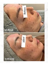 エヌプラス(N+)/40代女性＊ピーリング1回後 (2)