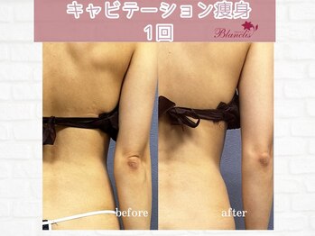 ブランリス(Blanclis)/痩身☆ビフォーアフター