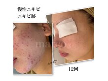 マルコ(marco)の雰囲気(marcoニキビケアシステム/ニキビ、毛穴)