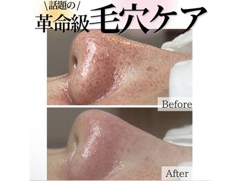 癒える(ielu)/毛穴B/A★2回目のお写真